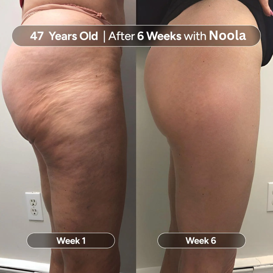 NoOil™ Anti-Cellulite Oil